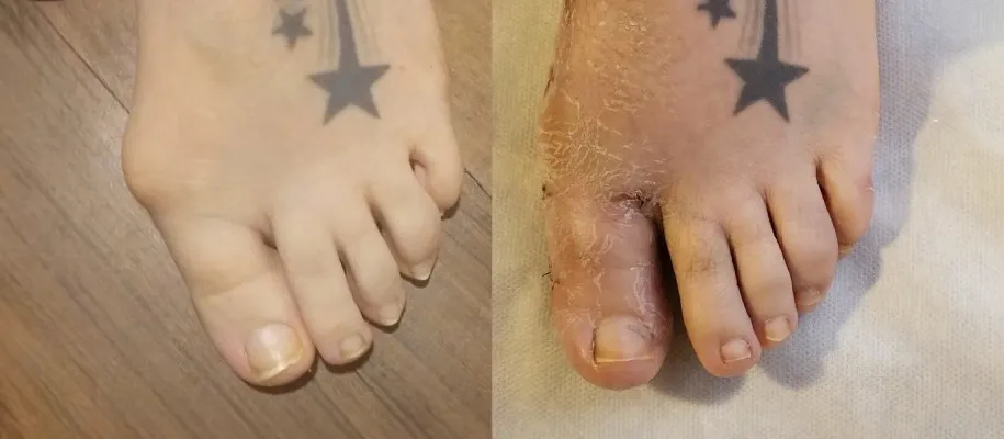 Before and after: The only solution for bunions is surgery