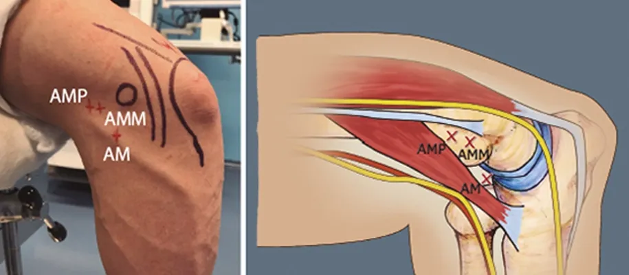 Patient recovery after elbow arthroscopy with physical therapy