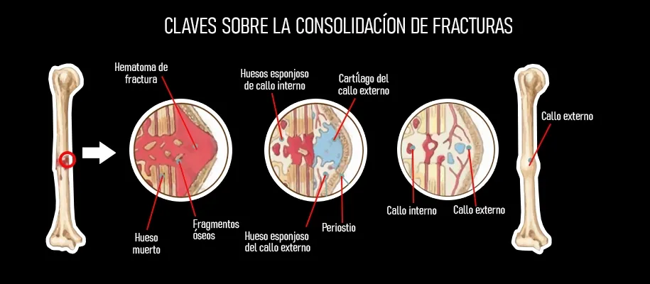 Comparative infographic: How smoking and diabetes affect bone fracture healing time