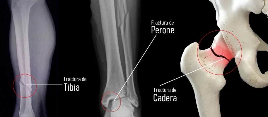 Dr. Monge's 4 bone fracture healing phases diagram - Inflammation, Soft Callus, Hard Callus, Remodeling