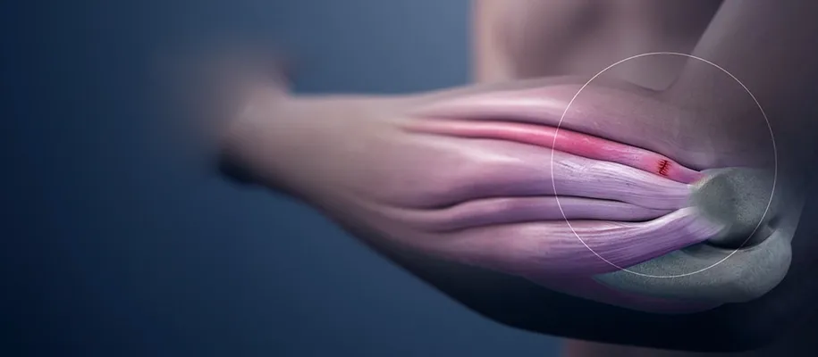 Imagen de fractura de tibia y peroné