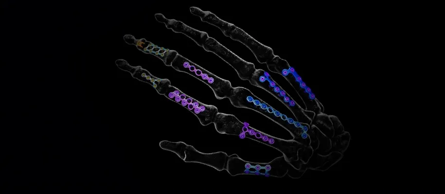 Bone fragment stability and alignment