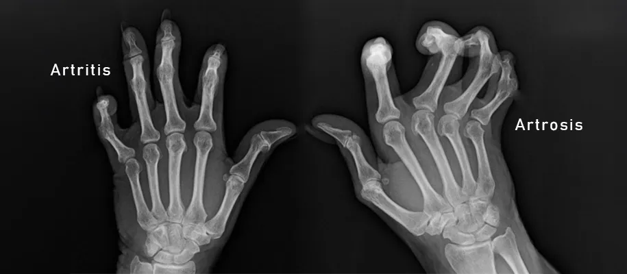 Imagen de fractura de tibia y peroné