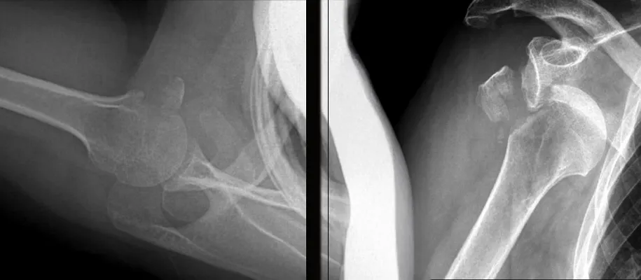 DR. Ricardo Monge simply explains proximal humerus fractures
