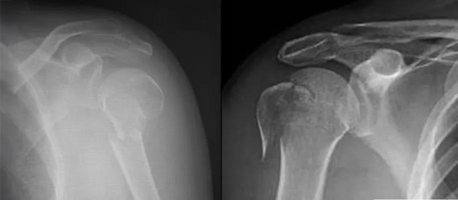 Image of proximal humerus fracture