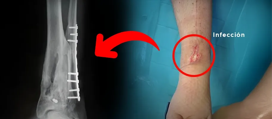 DR. Ricardo Monge simply explains the main symptoms of nonunion