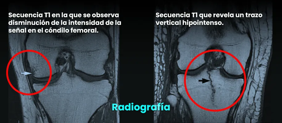 DR. Ricardo Monge simply explains the main symptoms of hidden fractures